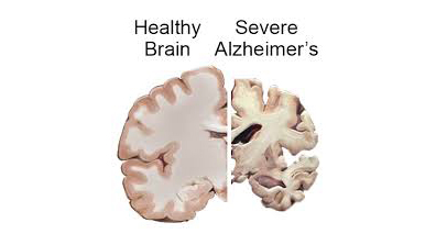 5 фактов о болезни Альцгеймера, которые вас насторожат