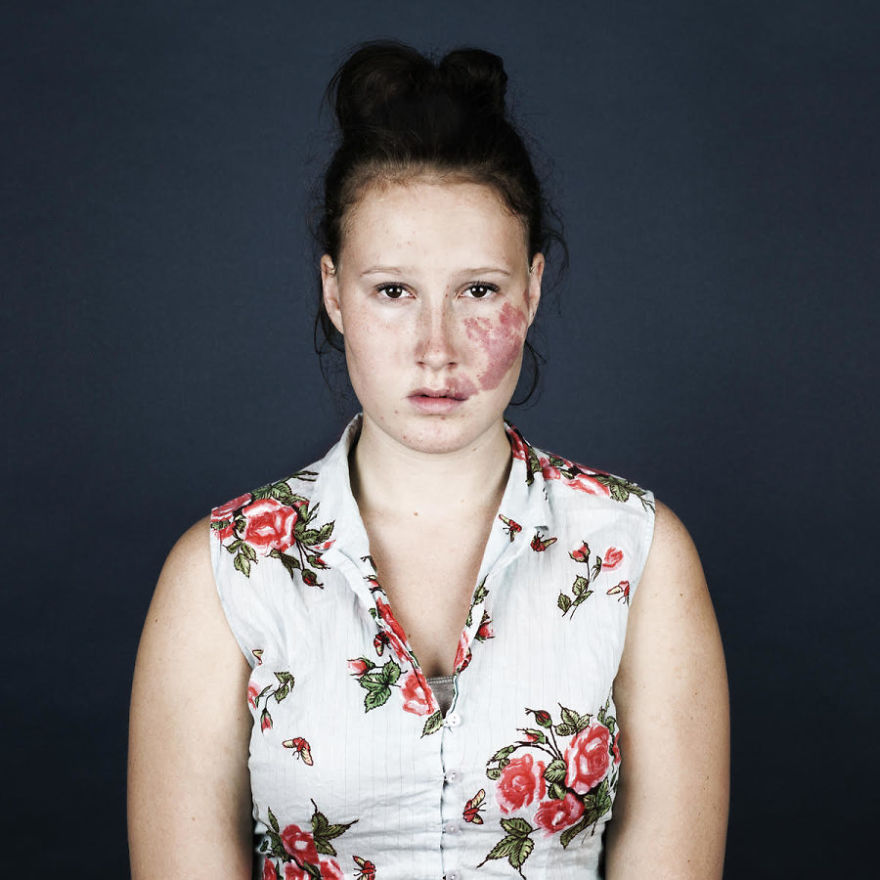 10 фотографий людей с родимыми пятнами, которые помогут вам рассмотреть за ними человека
