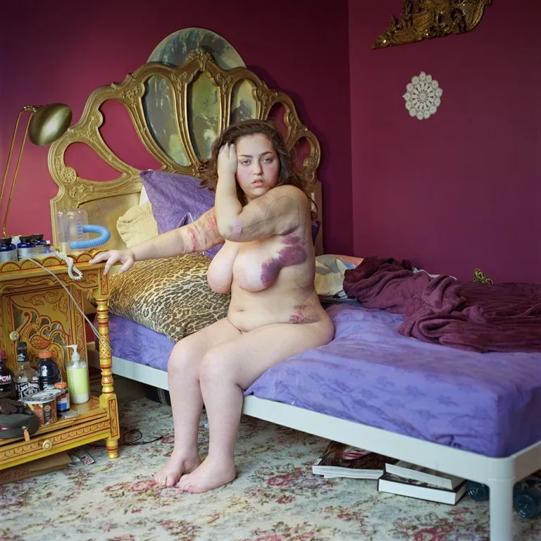 Фотографка рассказывает истории людей с редкими заболеваниями в своих снимках